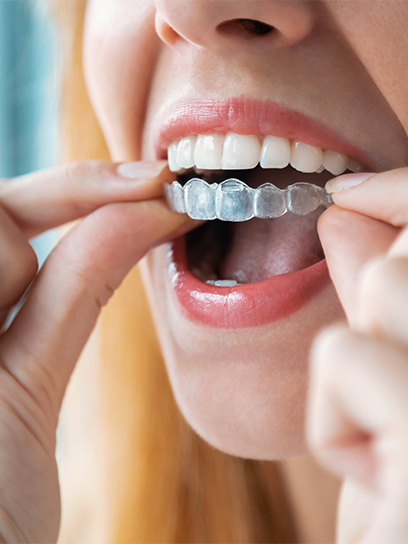 invisalign costs